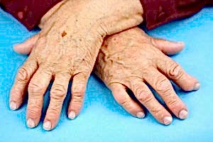 артрит у пожилых